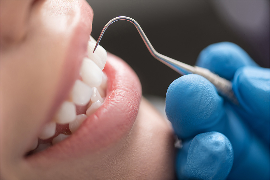 予防・クリーニング